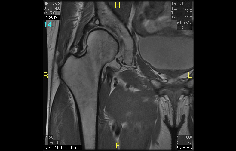 Figure 2 for case History Perthes Disease
